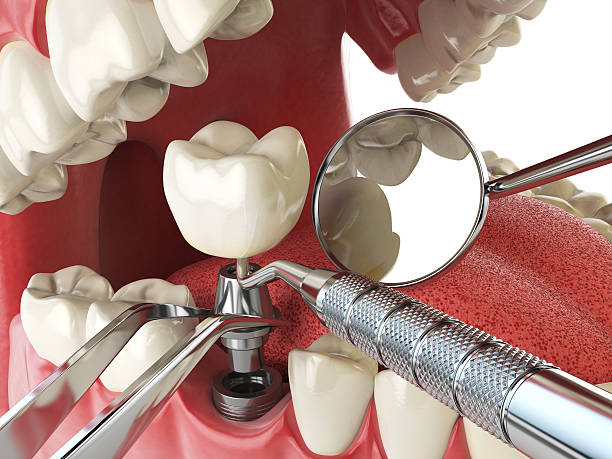 Best Urgent Care for Lost Fillings or Crowns in Milan, MO
